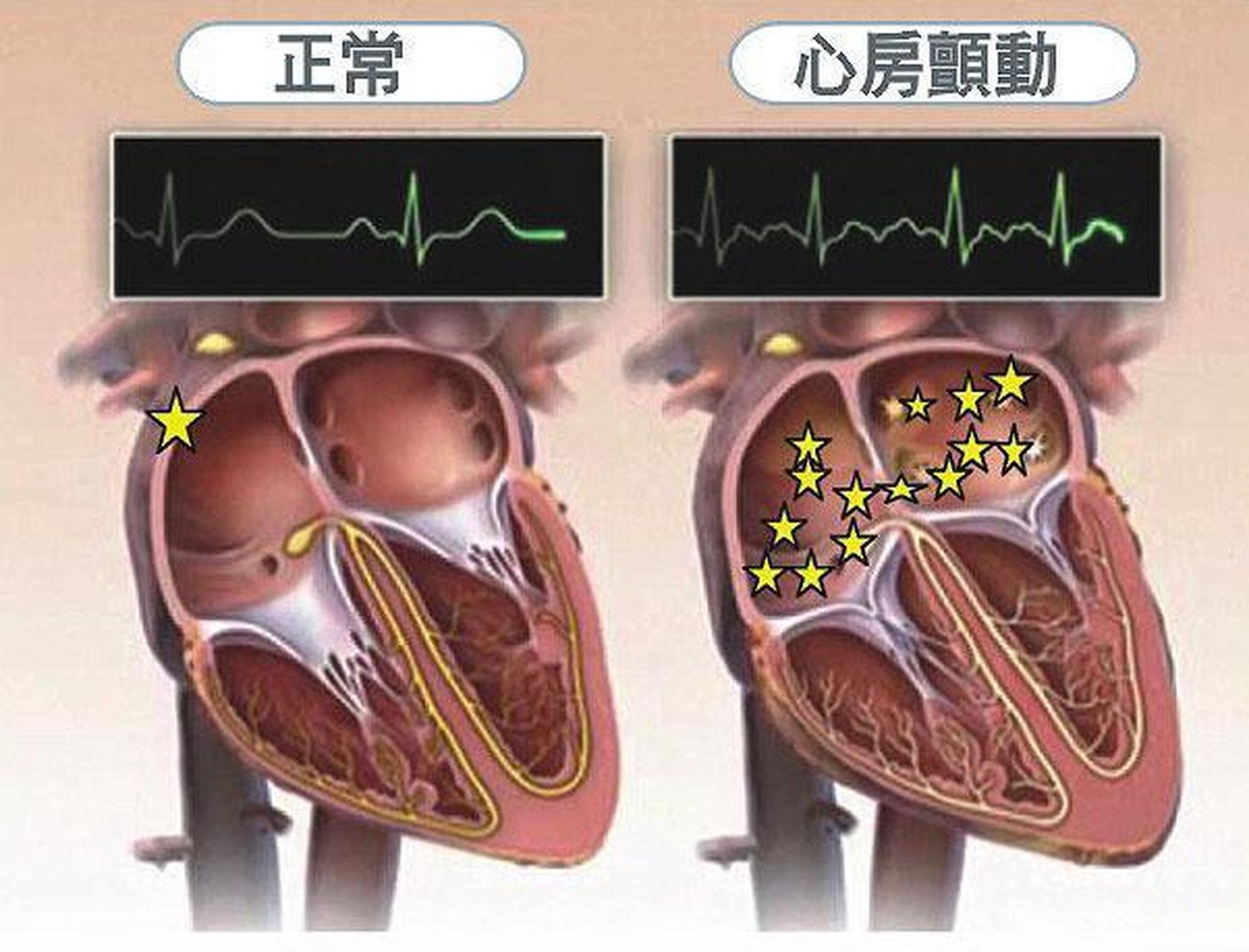 房颤吧最新资讯，全面指南助你应对房颤挑战